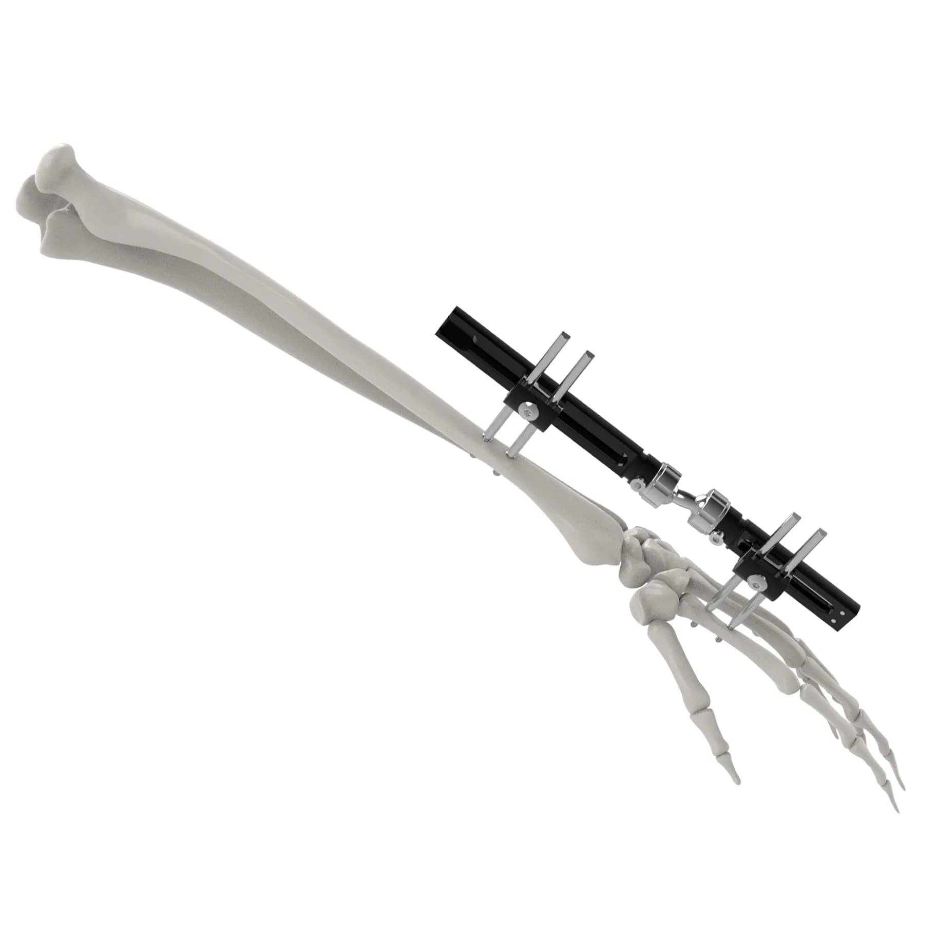 Canwell Small Bones Fracture Fixation Mini External Fixator Orthopedic Trauma Implant System for Phalanges and Metacarpals