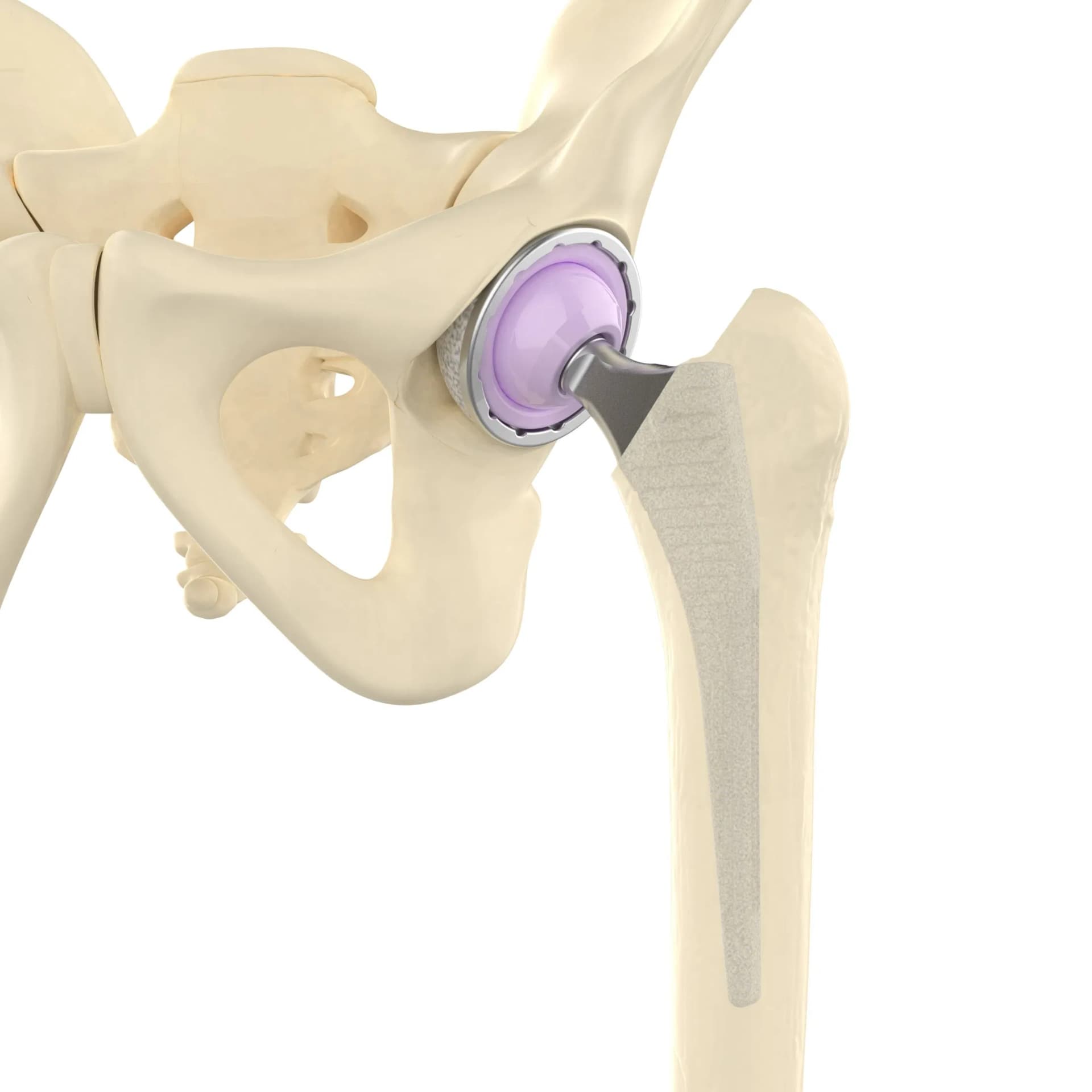 Canwell Primary UHMWPE Liner Revision Polyethylene Liner Exchange Total Hip Arthroplasty Prosthesis Joint Replacement CE